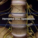 2 Herniated Disc
